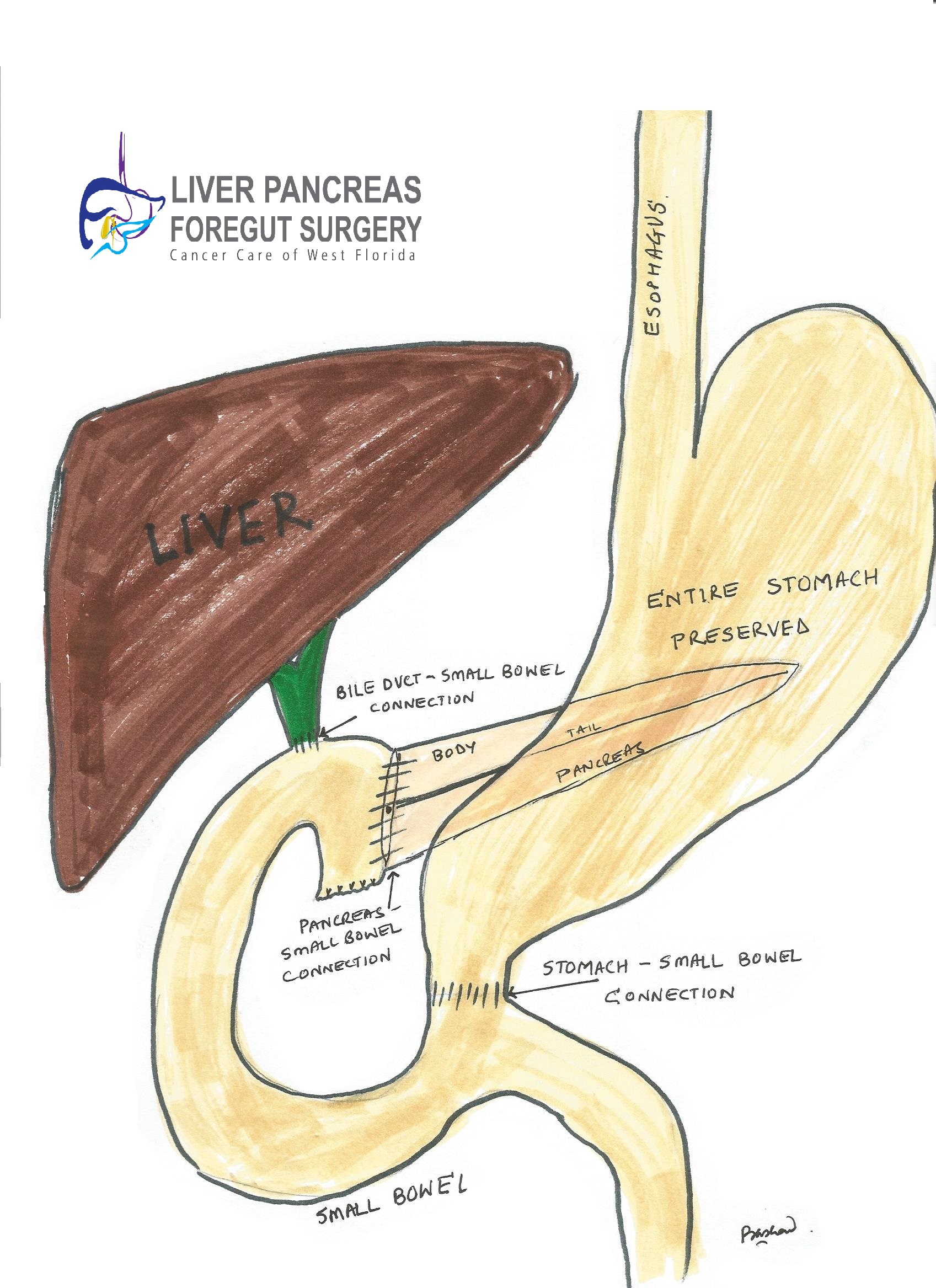 Pancreatitis treatment, Pancreas Surgery Tampa Florida | Liver Pancreas